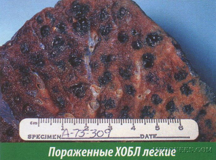 Пораженные ХОБЛ легкие Пораженные ХОБЛ легкие