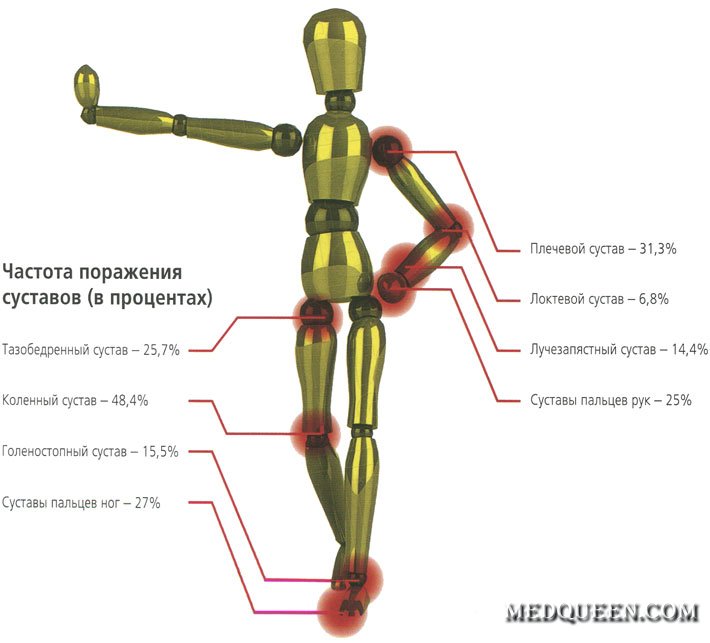 Частота поражения суставов Частота поражения суставов