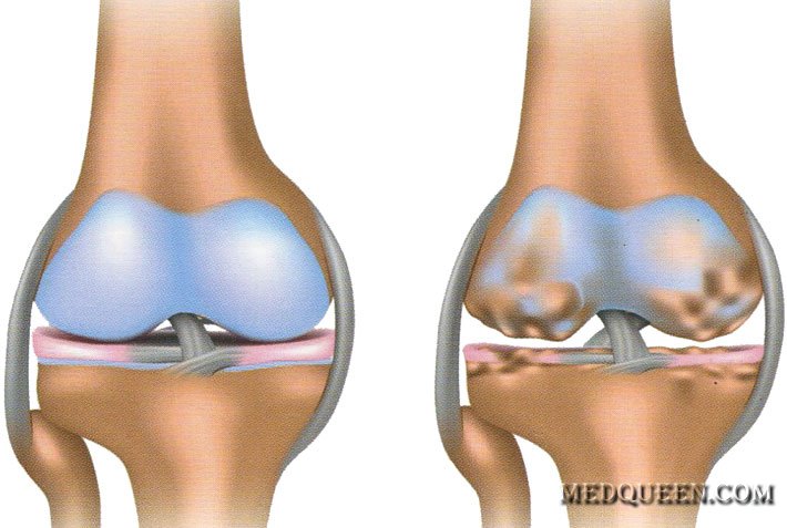 Остеоартроз Остеоартроз
