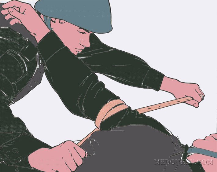 Остановка кровотечения из раны верхней конечности (взаимопомощь) Остановка кровотечения из раны верхней конечности (взаимопомощь)