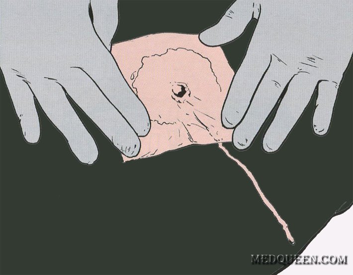 НАЛОЖЕНИЕ ПОВЯЗКИ НА ГРУДНУЮ КЛЕТКУ НАЛОЖЕНИЕ ПОВЯЗКИ НА ГРУДНУЮ КЛЕТКУ