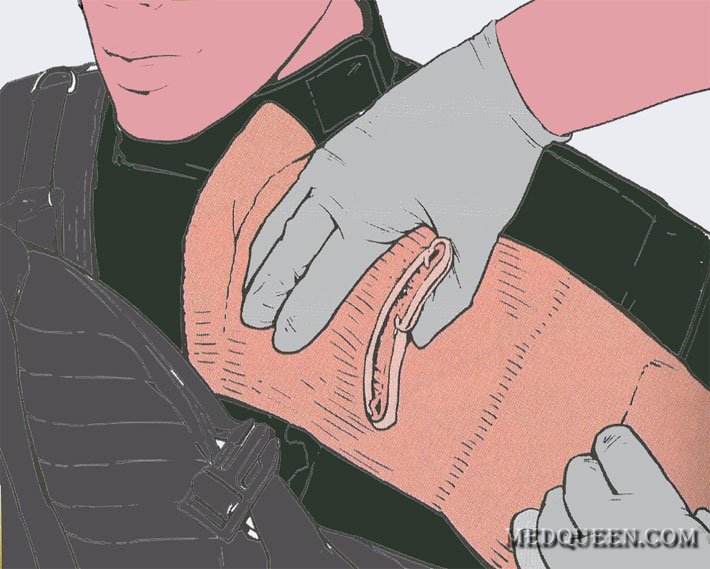 ОСТАНОВКА КРОВОТЕЧЕНИЯ ИЗ РАНЫ ТУЛОВИЩА ПРИ ПОМОЩИ ГЕМОСТАТИЧЕСКИХ СРЕДСТВ ОСТАНОВКА КРОВОТЕЧЕНИЯ ИЗ РАНЫ ТУЛОВИЩА ПРИ ПОМОЩИ ГЕМОСТАТИЧЕСКИХ СРЕДСТВ