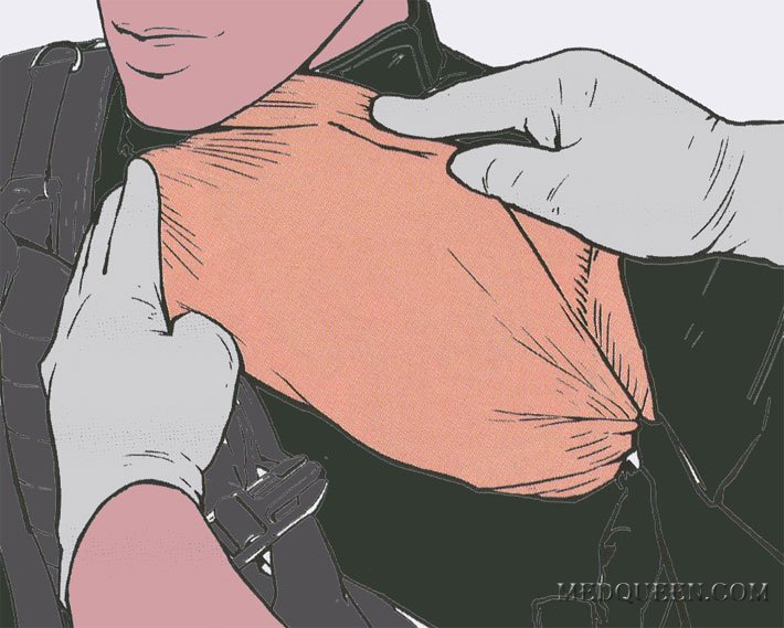 ОСТАНОВКА КРОВОТЕЧЕНИЯ ИЗ РАНЫ ТУЛОВИЩА ПРИ ПОМОЩИ ГЕМОСТАТИЧЕСКИХ СРЕДСТВ ОСТАНОВКА КРОВОТЕЧЕНИЯ ИЗ РАНЫ ТУЛОВИЩА ПРИ ПОМОЩИ ГЕМОСТАТИЧЕСКИХ СРЕДСТВ