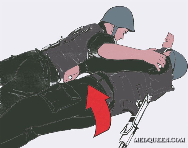 Перевод раненного в положение на бок (живот) Перевод раненного в положение на бок (живот)