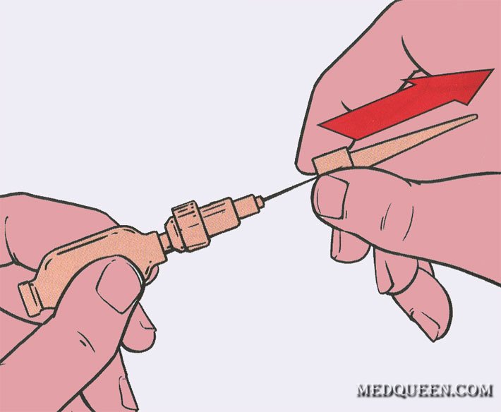 ВВЕДЕНИЕ ОБЕЗБОЛИВАЮЩИХ СРЕДСТВ ПРИ ПОМОЩИ ШПРИЦ-ТЮБИКА ВВЕДЕНИЕ ОБЕЗБОЛИВАЮЩИХ СРЕДСТВ ПРИ ПОМОЩИ ШПРИЦ-ТЮБИКА
