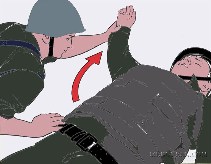 Перевод раненного в положение на бок (живот) Перевод раненного в положение на бок (живот)