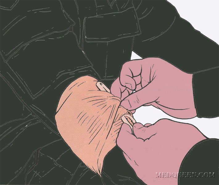 ОСТАНОВКА КРОВОТЕЧЕНИЯ ИЗ РАНЫ КОНЕЧНОСТИ ПРИ ПОМОЩИ СПЕЦИАЛЬНЫХ ПЕРЕВЯЗОЧНЫХ ПАКЕТОВ ОСТАНОВКА КРОВОТЕЧЕНИЯ ИЗ РАНЫ КОНЕЧНОСТИ ПРИ ПОМОЩИ СПЕЦИАЛЬНЫХ ПЕРЕВЯЗОЧНЫХ ПАКЕТОВ