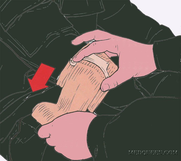 ОСТАНОВКА КРОВОТЕЧЕНИЯ ИЗ РАНЫ КОНЕЧНОСТИ ПРИ ПОМОЩИ СПЕЦИАЛЬНЫХ ПЕРЕВЯЗОЧНЫХ ПАКЕТОВ ОСТАНОВКА КРОВОТЕЧЕНИЯ ИЗ РАНЫ КОНЕЧНОСТИ ПРИ ПОМОЩИ СПЕЦИАЛЬНЫХ ПЕРЕВЯЗОЧНЫХ ПАКЕТОВ