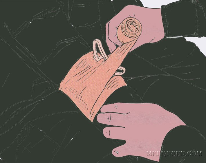 ОСТАНОВКА КРОВОТЕЧЕНИЯ ИЗ РАНЫ КОНЕЧНОСТИ ПРИ ПОМОЩИ СПЕЦИАЛЬНЫХ ПЕРЕВЯЗОЧНЫХ ПАКЕТОВ ОСТАНОВКА КРОВОТЕЧЕНИЯ ИЗ РАНЫ КОНЕЧНОСТИ ПРИ ПОМОЩИ СПЕЦИАЛЬНЫХ ПЕРЕВЯЗОЧНЫХ ПАКЕТОВ