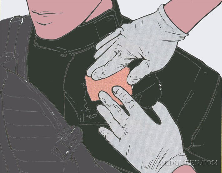 ОСТАНОВКА КРОВОТЕЧЕНИЯ ИЗ РАНЫ ТУЛОВИЩА ПРИ ПОМОЩИ ГЕМОСТАТИЧЕСКИХ СРЕДСТВ ОСТАНОВКА КРОВОТЕЧЕНИЯ ИЗ РАНЫ ТУЛОВИЩА ПРИ ПОМОЩИ ГЕМОСТАТИЧЕСКИХ СРЕДСТВ