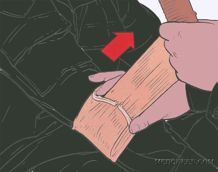 ОСТАНОВКА КРОВОТЕЧЕНИЯ ИЗ РАНЫ КОНЕЧНОСТИ ПРИ ПОМОЩИ СПЕЦИАЛЬНЫХ ПЕРЕВЯЗОЧНЫХ ПАКЕТОВ ОСТАНОВКА КРОВОТЕЧЕНИЯ ИЗ РАНЫ КОНЕЧНОСТИ ПРИ ПОМОЩИ СПЕЦИАЛЬНЫХ ПЕРЕВЯЗОЧНЫХ ПАКЕТОВ