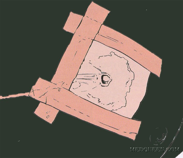 НАЛОЖЕНИЕ ПОВЯЗКИ НА ГРУДНУЮ КЛЕТКУ НАЛОЖЕНИЕ ПОВЯЗКИ НА ГРУДНУЮ КЛЕТКУ