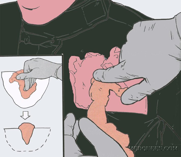 ОСТАНОВКА КРОВОТЕЧЕНИЯ ИЗ РАНЫ ТУЛОВИЩА ПРИ ПОМОЩИ ГЕМОСТАТИЧЕСКИХ СРЕДСТВ ОСТАНОВКА КРОВОТЕЧЕНИЯ ИЗ РАНЫ ТУЛОВИЩА ПРИ ПОМОЩИ ГЕМОСТАТИЧЕСКИХ СРЕДСТВ