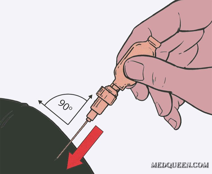 ВВЕДЕНИЕ ОБЕЗБОЛИВАЮЩИХ СРЕДСТВ ПРИ ПОМОЩИ ШПРИЦ-ТЮБИКА ВВЕДЕНИЕ ОБЕЗБОЛИВАЮЩИХ СРЕДСТВ ПРИ ПОМОЩИ ШПРИЦ-ТЮБИКА