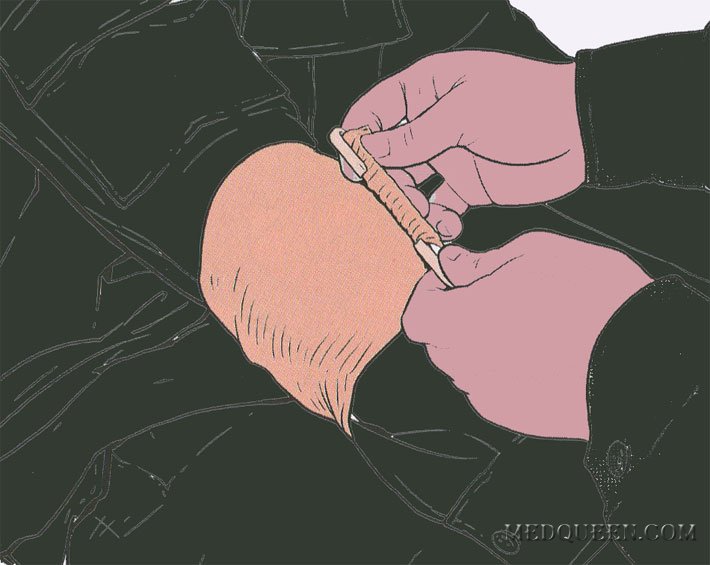 ОСТАНОВКА КРОВОТЕЧЕНИЯ ИЗ РАНЫ КОНЕЧНОСТИ ПРИ ПОМОЩИ СПЕЦИАЛЬНЫХ ПЕРЕВЯЗОЧНЫХ ПАКЕТОВ ОСТАНОВКА КРОВОТЕЧЕНИЯ ИЗ РАНЫ КОНЕЧНОСТИ ПРИ ПОМОЩИ СПЕЦИАЛЬНЫХ ПЕРЕВЯЗОЧНЫХ ПАКЕТОВ