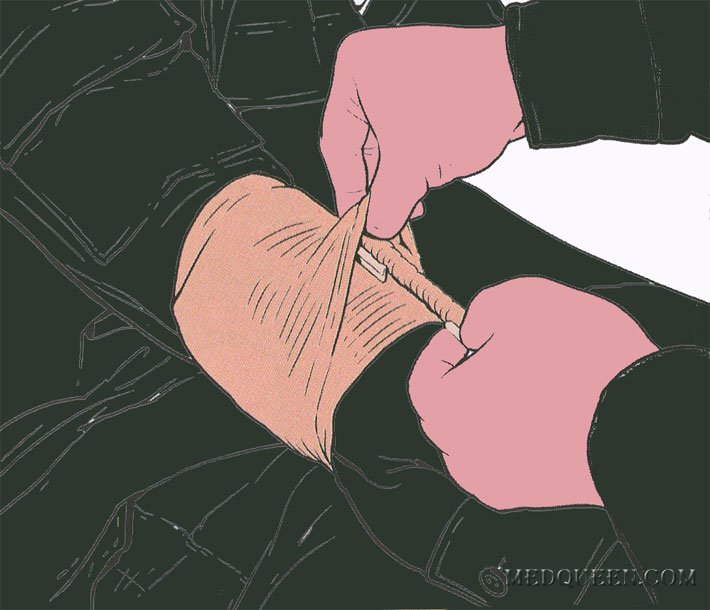 ОСТАНОВКА КРОВОТЕЧЕНИЯ ИЗ РАНЫ КОНЕЧНОСТИ ПРИ ПОМОЩИ СПЕЦИАЛЬНЫХ ПЕРЕВЯЗОЧНЫХ ПАКЕТОВ ОСТАНОВКА КРОВОТЕЧЕНИЯ ИЗ РАНЫ КОНЕЧНОСТИ ПРИ ПОМОЩИ СПЕЦИАЛЬНЫХ ПЕРЕВЯЗОЧНЫХ ПАКЕТОВ