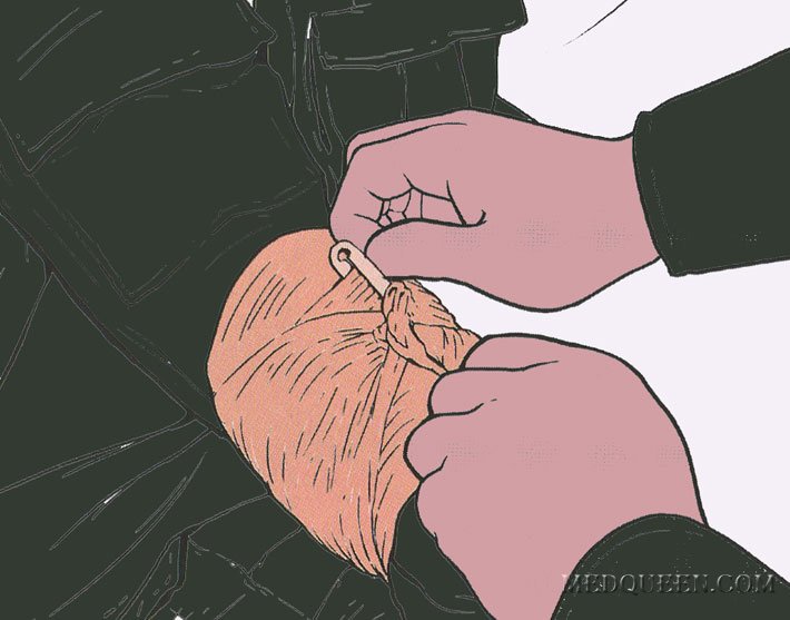 ОСТАНОВКА КРОВОТЕЧЕНИЯ ИЗ РАНЫ КОНЕЧНОСТИ ПРИ ПОМОЩИ СПЕЦИАЛЬНЫХ ПЕРЕВЯЗОЧНЫХ ПАКЕТОВ ОСТАНОВКА КРОВОТЕЧЕНИЯ ИЗ РАНЫ КОНЕЧНОСТИ ПРИ ПОМОЩИ СПЕЦИАЛЬНЫХ ПЕРЕВЯЗОЧНЫХ ПАКЕТОВ