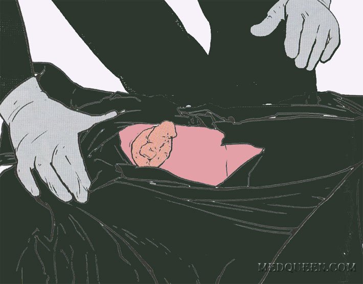 НАЛОЖЕНИЕ ПОВЯЗКИ НА ЖИВОТ НАЛОЖЕНИЕ ПОВЯЗКИ НА ЖИВОТ