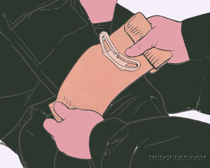 ОСТАНОВКА КРОВОТЕЧЕНИЯ ИЗ РАНЫ КОНЕЧНОСТИ ПРИ ПОМОЩИ СПЕЦИАЛЬНЫХ ПЕРЕВЯЗОЧНЫХ ПАКЕТОВ ОСТАНОВКА КРОВОТЕЧЕНИЯ ИЗ РАНЫ КОНЕЧНОСТИ ПРИ ПОМОЩИ СПЕЦИАЛЬНЫХ ПЕРЕВЯЗОЧНЫХ ПАКЕТОВ