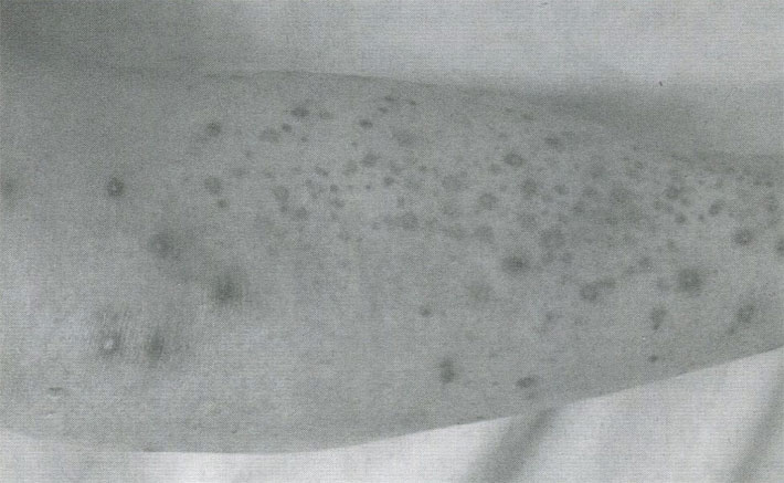 Пурпура с пустулезными элементами на голени при лейкоцитокластическом васкулите Пурпура с пустулезными элементами на голени при лейкоцитокластическом васкулите