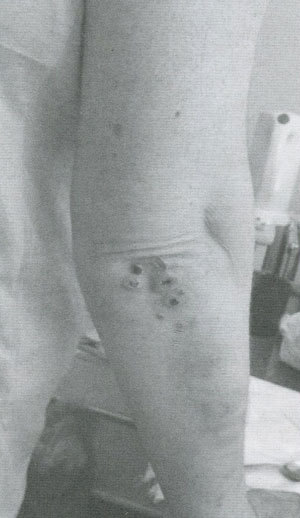 Папуло-некротическая сыпь на локте у больной ГПА Папуло-некротическая сыпь на локте у больной ГПА