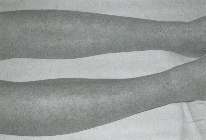 Пурпура разной давности на голенях при геморрагическом васкулите Пурпура разной давности на голенях при геморрагическом васкулите