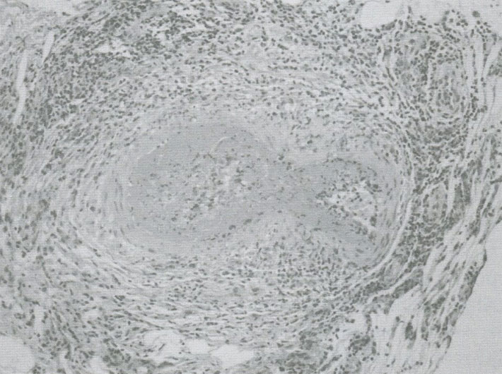 Узелковый полиартериит. Некротизивный васкулит сосудов среднего калибра Узелковый полиартериит. Некротизивный васкулит сосудов среднего калибра