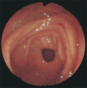 Эндоскопия двенадцатиперстной кишки Эндоскопия двенадцатиперстной кишки