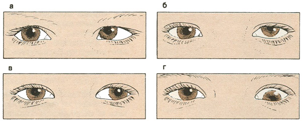 Типы косоглазия Типы косоглазия