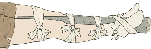 Травма ноги Травма ноги