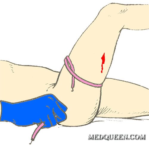 Остановка кровотечения Остановка кровотечения