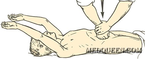 Остановка кровотечения Остановка кровотечения