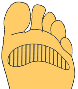 Мозоли Мозоли