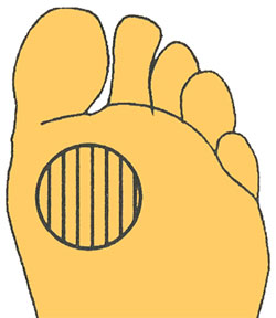 Мозоли Мозоли