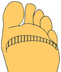 Мозоли Мозоли