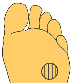 Мозоли Мозоли