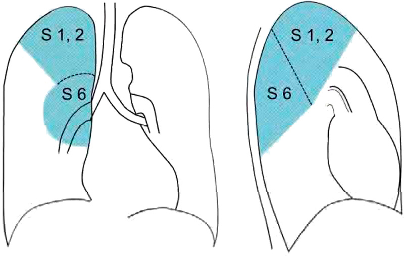 Вторичный туберкулез легких Вторичный туберкулез легких