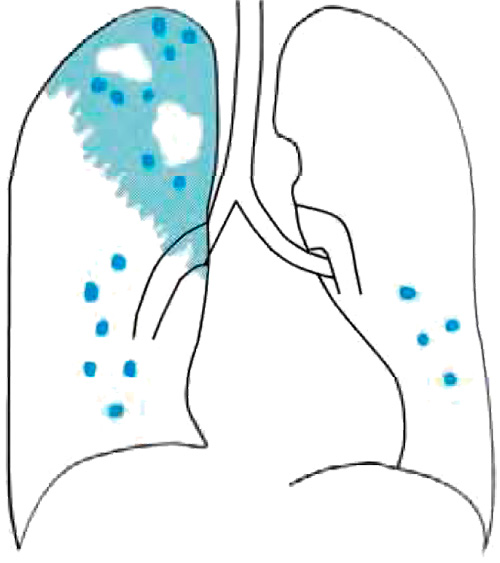 Туберкулезный процесс в легких Туберкулезный процесс в легких