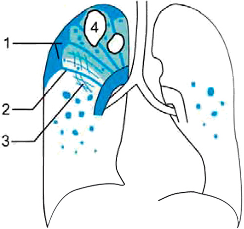 Хронический туберкулез легких Хронический туберкулез легких