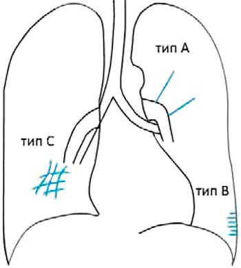 Линии Керли Линии Керли