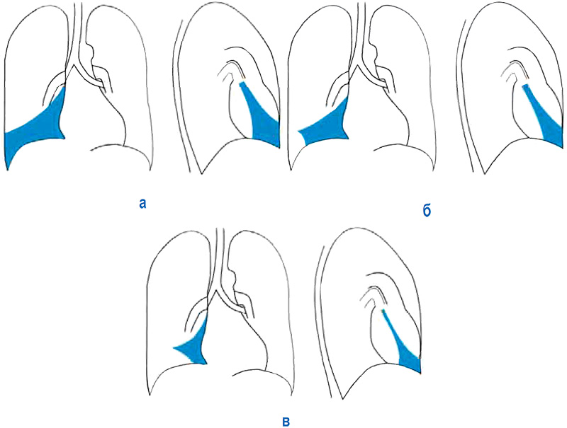 Ателектаз Ателектаз