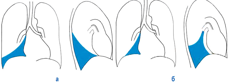 Ателектаз Ателектаз