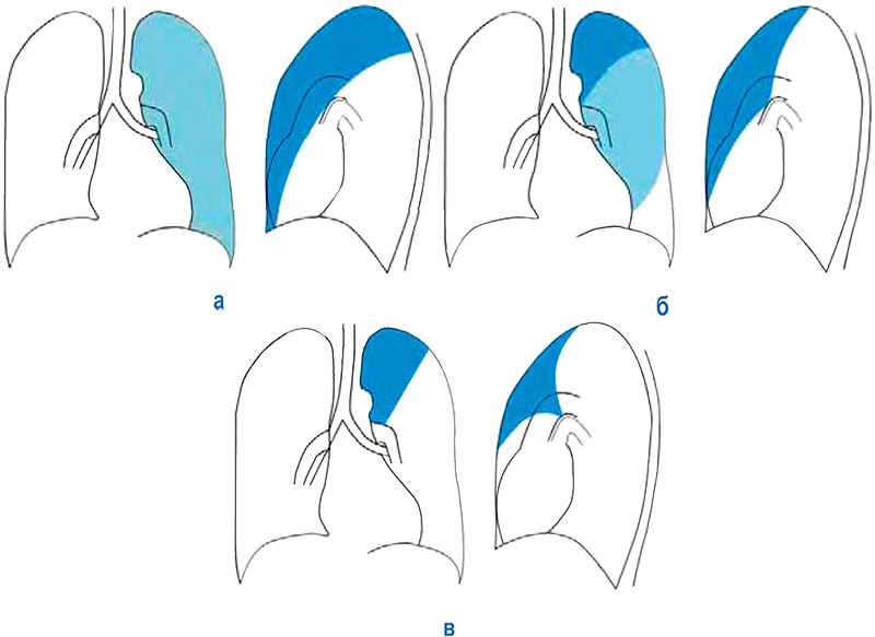 Ателектаз Ателектаз