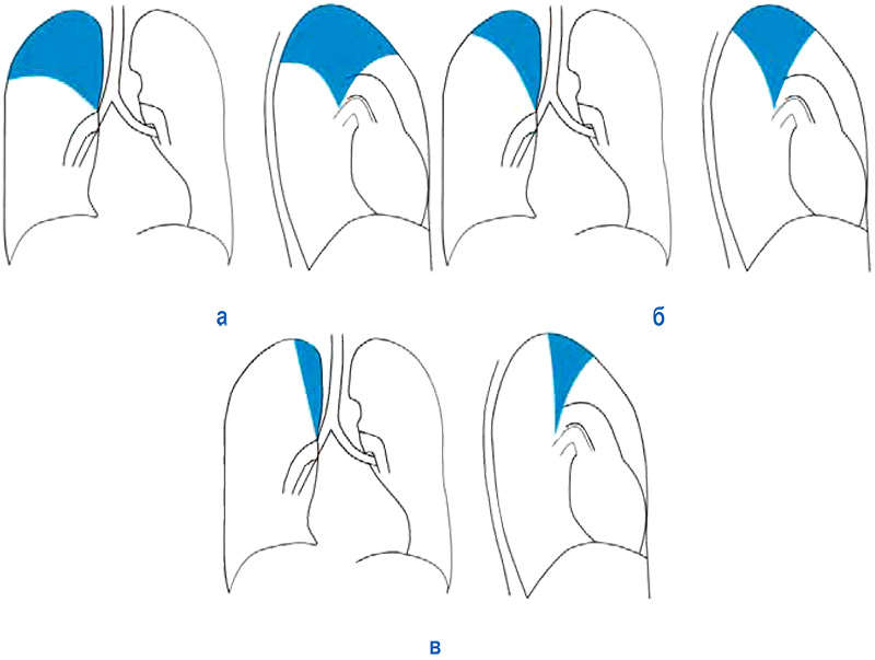 Ателектаз Ателектаз