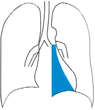 Ателектаз Ателектаз