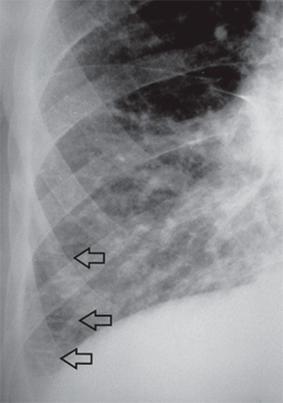 Линии Керли типа В Линии Керли типа В