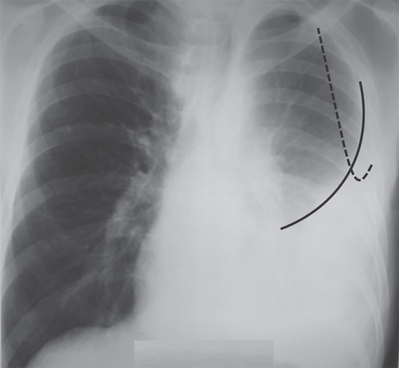 Гидроторакс Гидроторакс