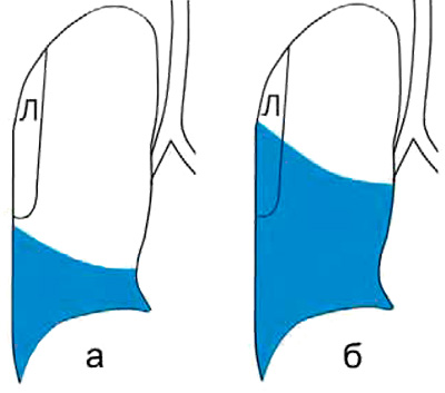Гидроторакс Гидроторакс