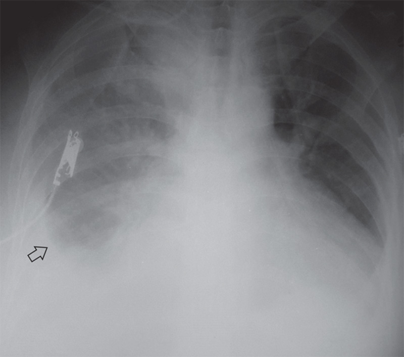 Гидроторакс Гидроторакс