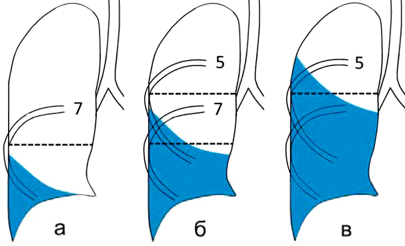 Гидроторакс Гидроторакс